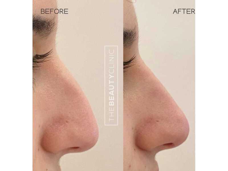liquid-rhinoplasty-miami-non-surgical-nose-reshaping-with-filler-small-0