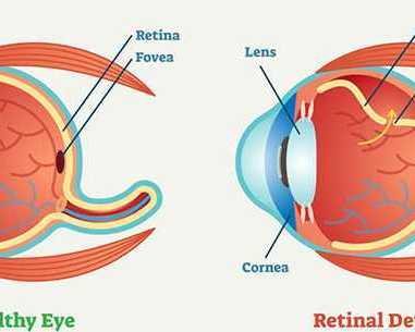 retinal-detachment-treatment-in-salem-massachusetts
