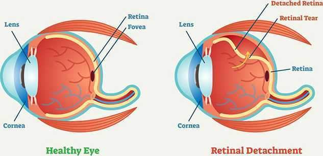 retinal-detachment-treatment-in-salem-massachusetts-big-0