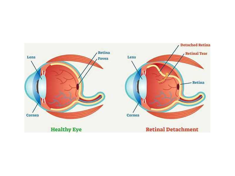 retinal-detachment-treatment-in-salem-massachusetts-small-0