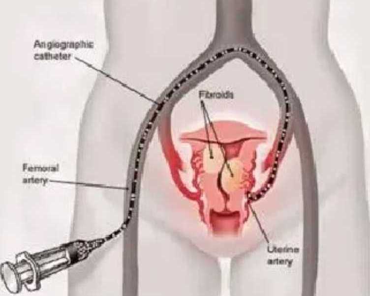 new-treatment-for-fibroids-without-surgery