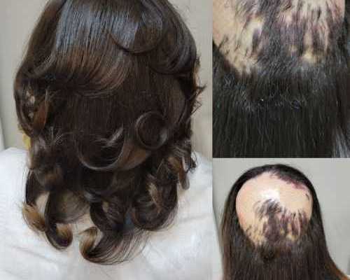 hair-loss-specialist-georgia-hair-clinique-restoration-center