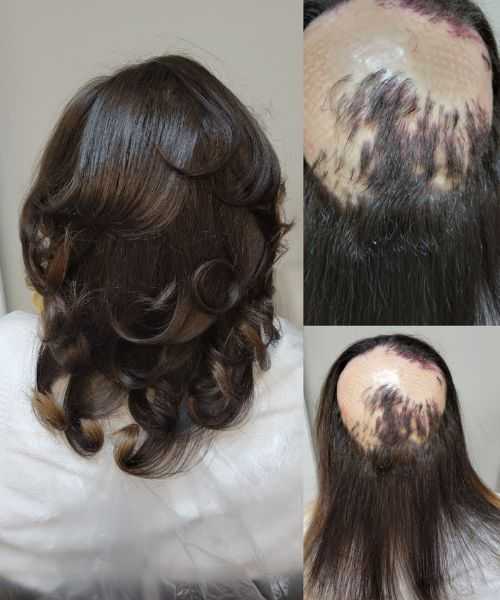 hair-loss-specialist-georgia-hair-clinique-restoration-center-big-0
