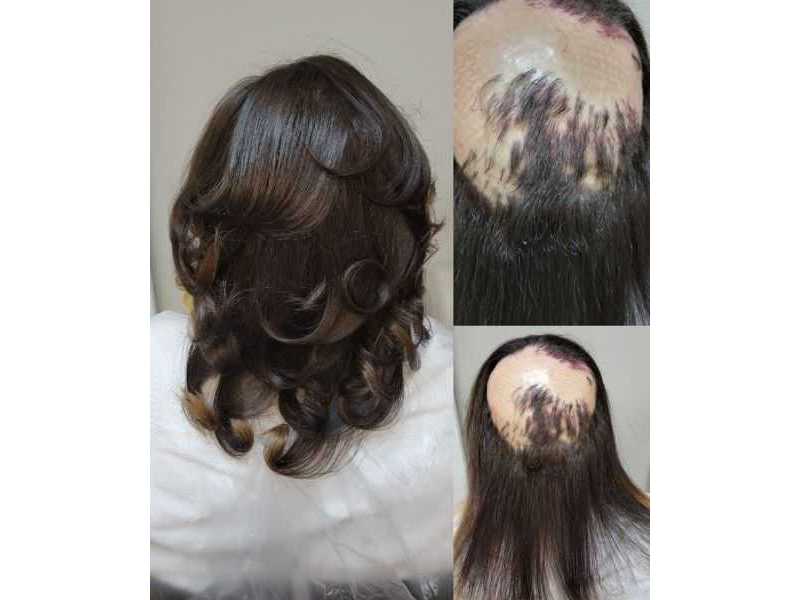 hair-loss-specialist-georgia-hair-clinique-restoration-center-small-0