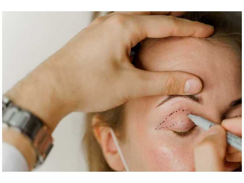 droopy-eyelid-repair-ptosis-treatment-services-in-fairfax-virginia-small-0