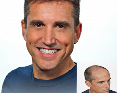 transform-hair-thinning-into-fuller-healthier-hair