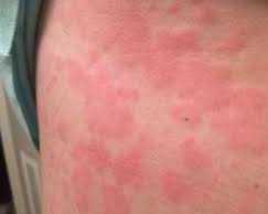 mast-cell-activation-syndrome