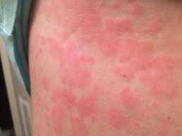 mast-cell-activation-syndrome-big-0