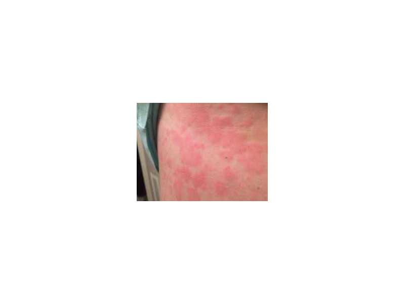 mast-cell-activation-syndrome-small-0
