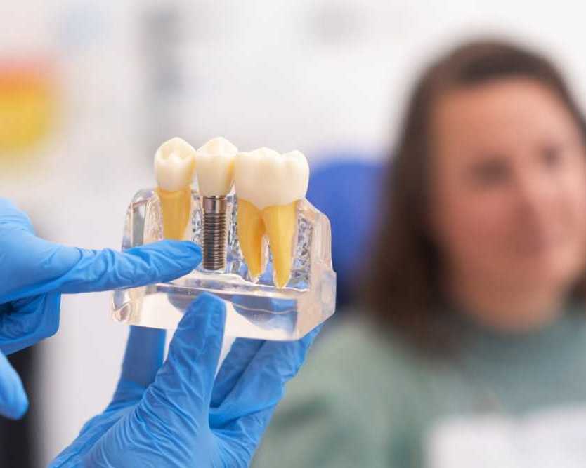 complete-smile-restoration-with-full-mouth-dental-implants