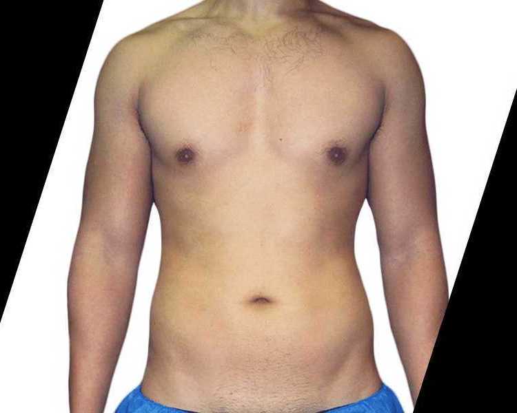 what-is-high-definition-liposuction-and-how-does