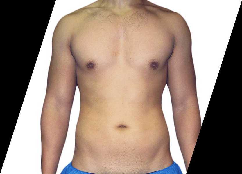what-is-high-definition-liposuction-and-how-does-big-0