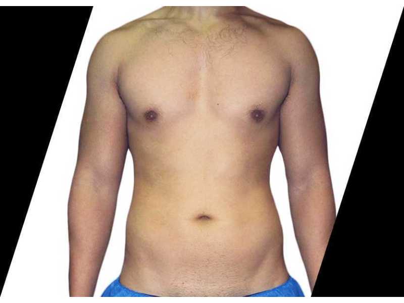 what-is-high-definition-liposuction-and-how-does-small-0