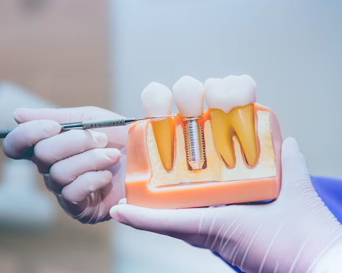 restore-your-smile-with-a-natural-front-dental-implant