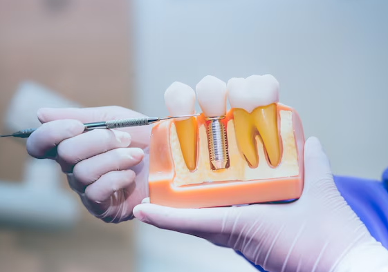 restore-your-smile-with-a-natural-front-dental-implant-big-0