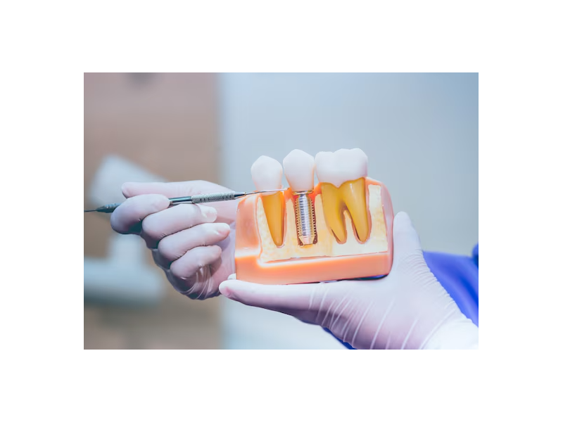restore-your-smile-with-a-natural-front-dental-implant-small-0