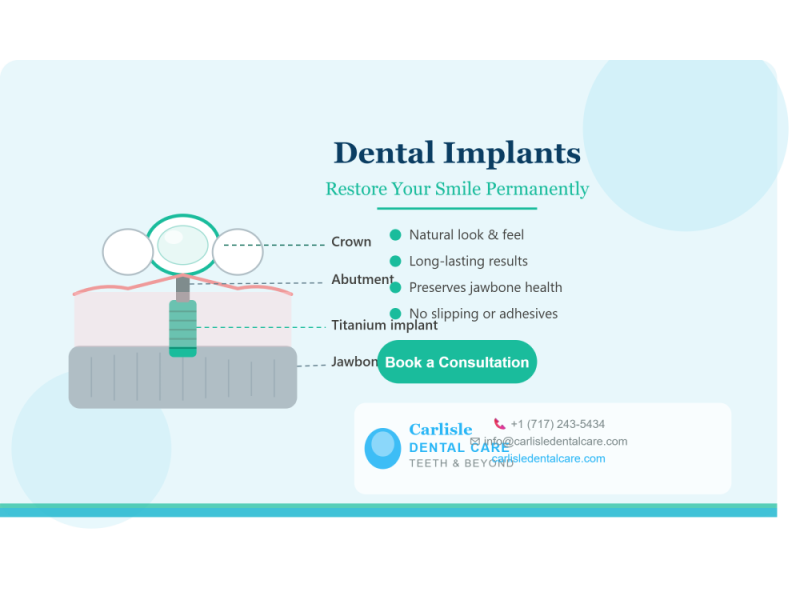 affordable-dental-implant-in-carlisle-pa-carlisle-dental-care-small-0