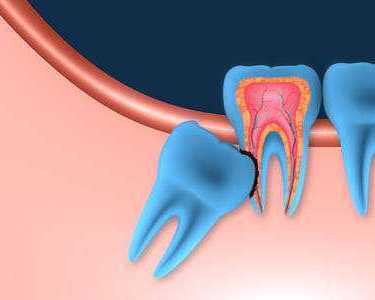 considering-extraction-for-wisdom-teeth-pinefield-dental