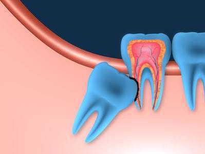 considering-extraction-for-wisdom-teeth-pinefield-dental-big-0