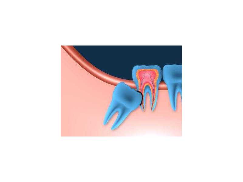 considering-extraction-for-wisdom-teeth-pinefield-dental-small-0