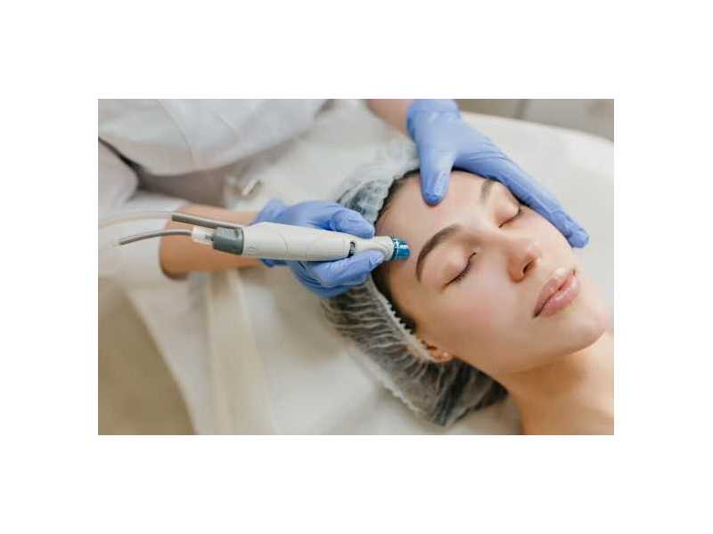 rf-microneedling-benefits-for-reducing-fine-lines-and-wrinkles-small-0