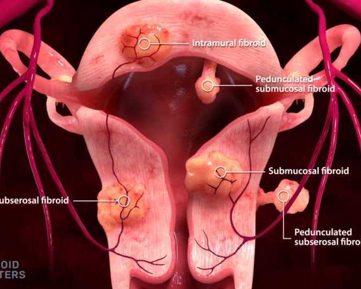 say-goodbye-to-fibroid-symptoms-without-surgery