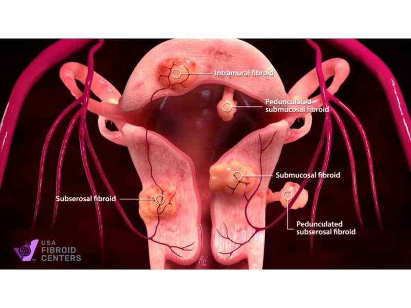say-goodbye-to-fibroid-symptoms-without-surgery-small-0