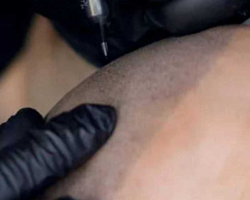 scalp-micropigmentation-chicago