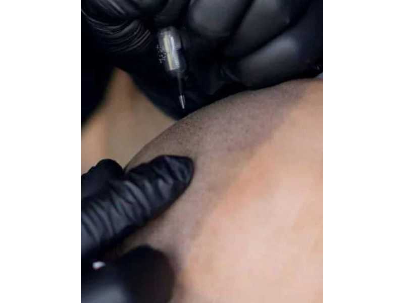 scalp-micropigmentation-chicago-small-0