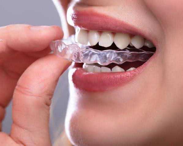 get-the-straight-smile-you-deserve-with-affordable-braces-in-houston