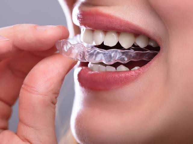 get-the-straight-smile-you-deserve-with-affordable-braces-in-houston-big-0