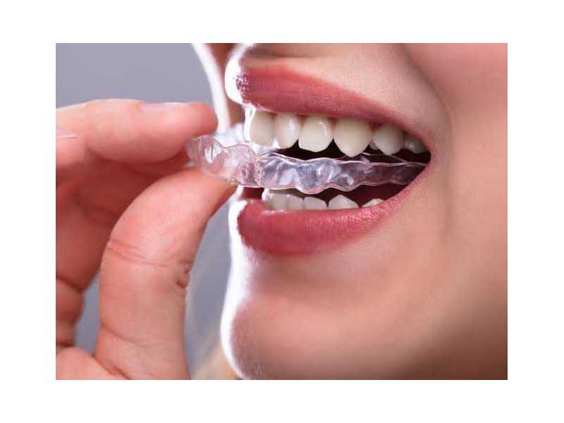 get-the-straight-smile-you-deserve-with-affordable-braces-in-houston-small-0