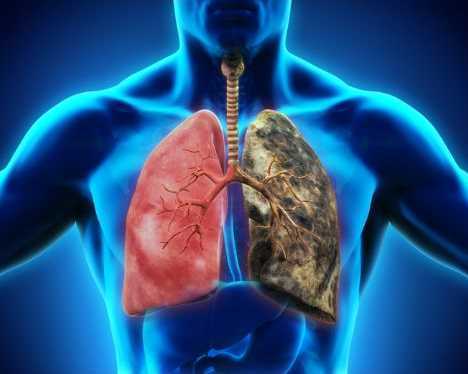 treatment-for-lung-cancer-stage-4