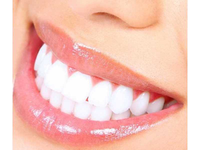 professional-teeth-whitening-in-san-antonio-tx-primo-dental-small-0