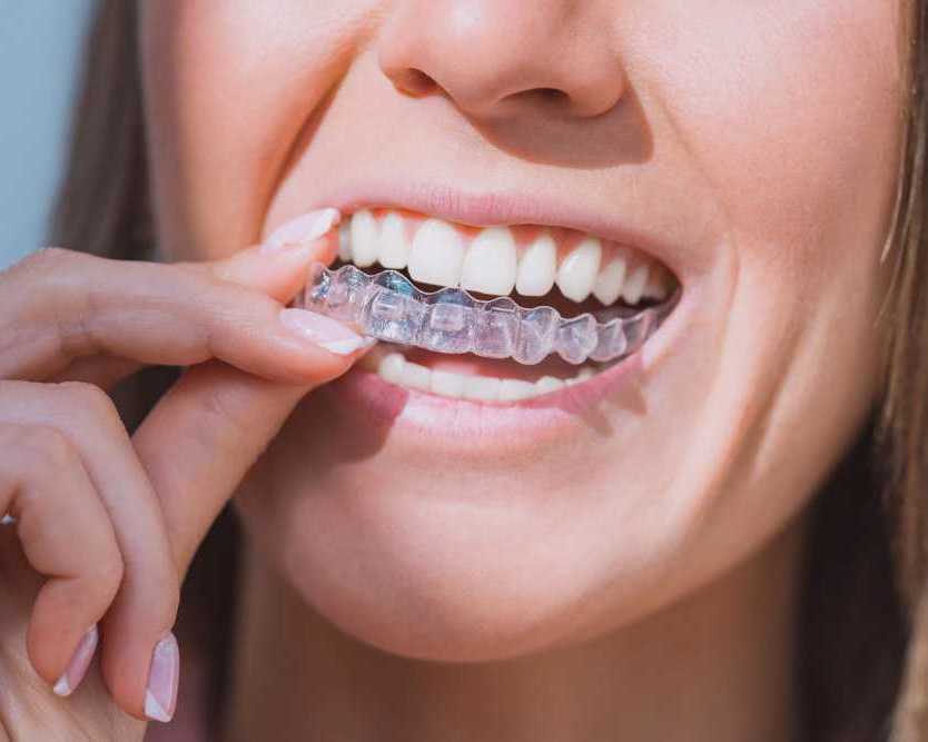 transform-your-smile-discreetly-with-clear-aligners-in-league-city