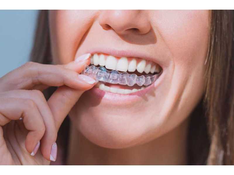 transform-your-smile-discreetly-with-clear-aligners-in-league-city-small-0