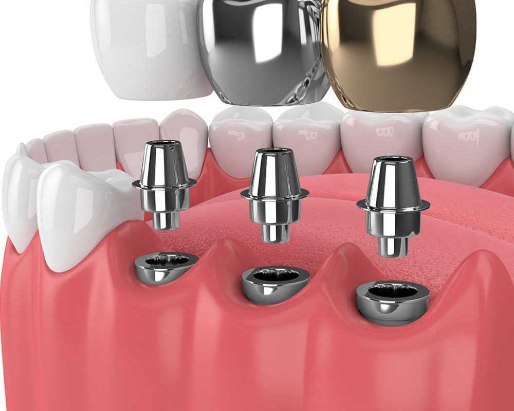 restore-your-smile-with-expert-dental-implants-in-elyson-tx