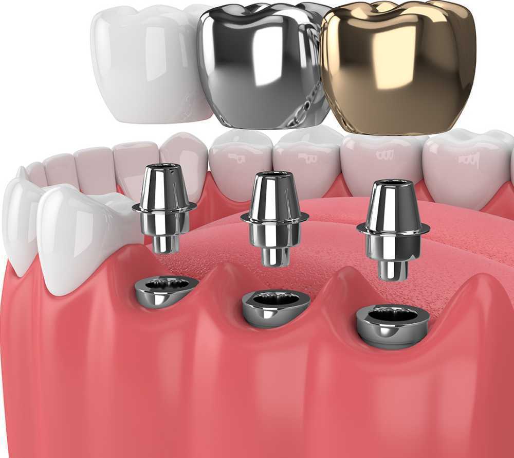 restore-your-smile-with-expert-dental-implants-in-elyson-tx-big-0