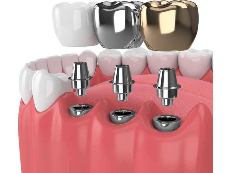 restore-your-smile-with-expert-dental-implants-in-elyson-tx-small-0