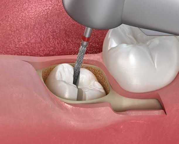 safe-and-professional-tooth-extraction-in-san-antonio-tx