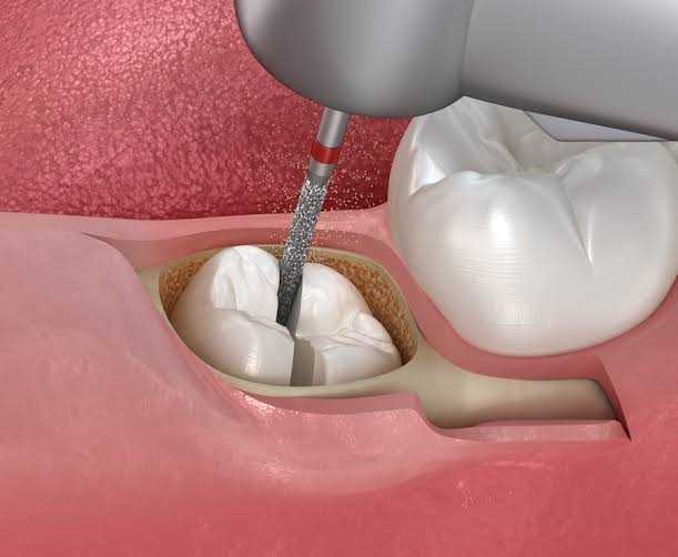 safe-and-professional-tooth-extraction-in-san-antonio-tx-big-0