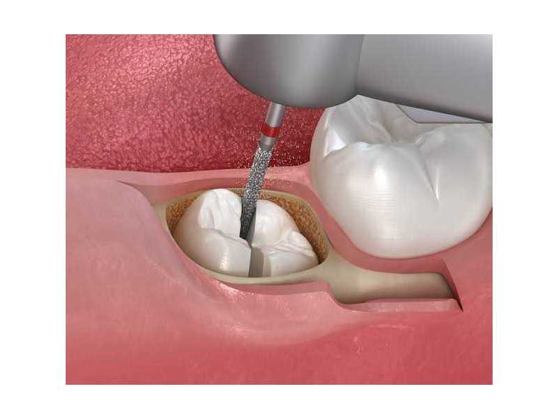 safe-and-professional-tooth-extraction-in-san-antonio-tx-small-0
