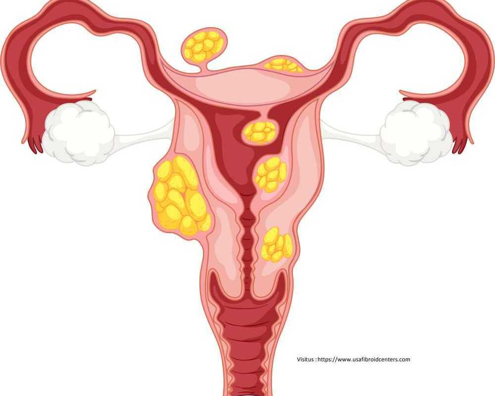 fibroid-clinic-in-lenox-hill-manhattan-new-york-specialized-care