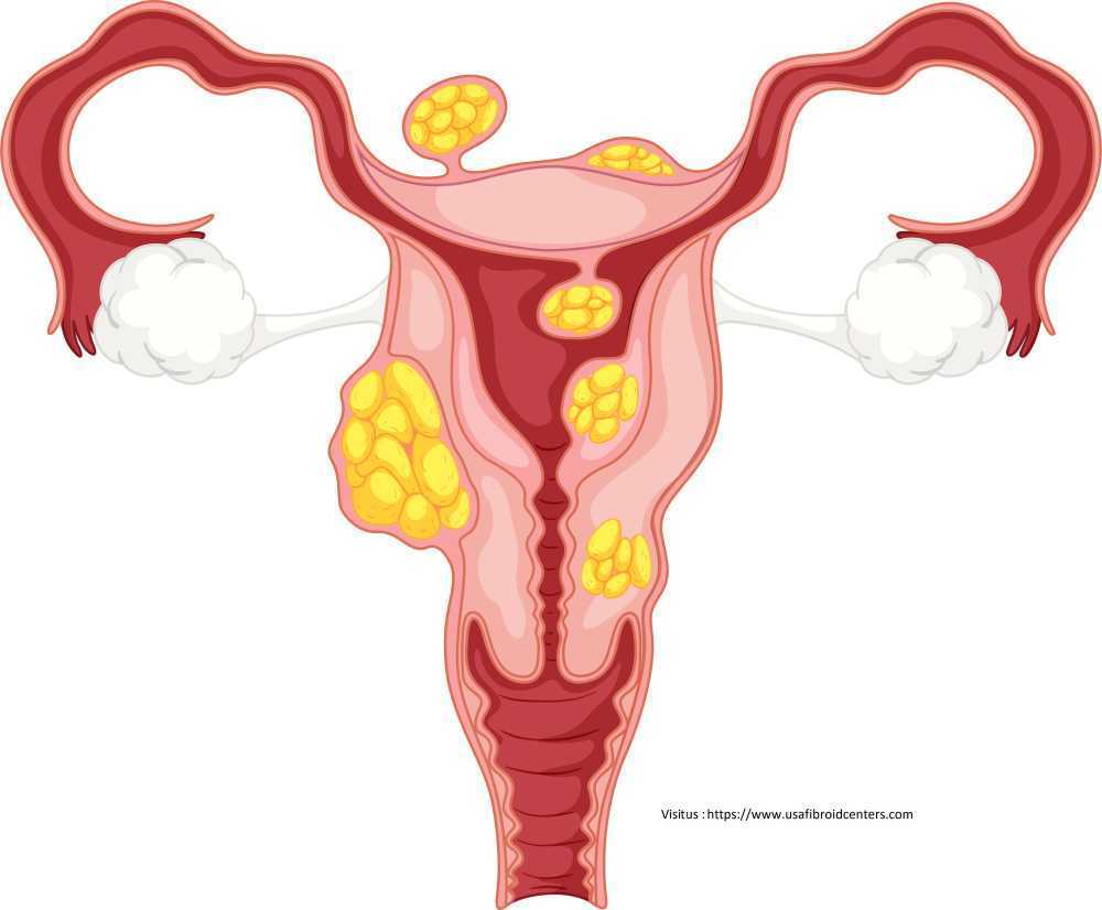 fibroid-clinic-in-lenox-hill-manhattan-new-york-specialized-care-big-0