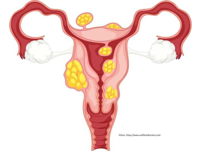 fibroid-clinic-in-lenox-hill-manhattan-new-york-specialized-care-small-0