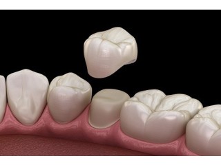 How much does a dental crown cost?