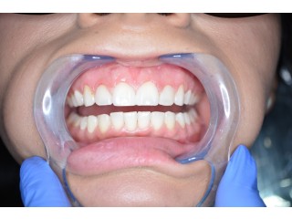 Teeth Whitening Dentist in Houston