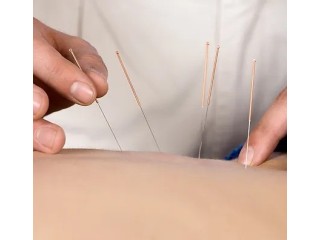 The Ultimate Guide To Acupuncture In Jacksonville, FL