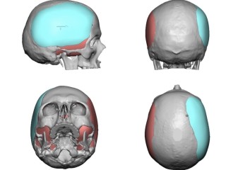 Skull Reshaping Surgery in San Francisco, CA