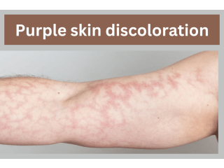 Purple Skin Discoloration: What You Need to Know